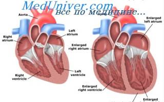 Застойная сердечная недостаточность симптомы