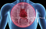 Застойная пневмония при сердечной недостаточности