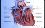 Ревматический порок сердца