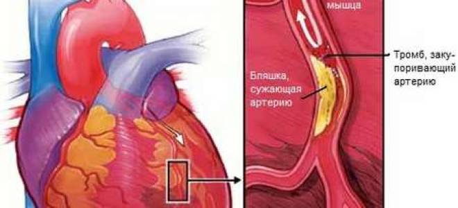 Как определить инфаркт миокарда по самочувствию