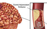 Геморрагический инфаркт головного мозга