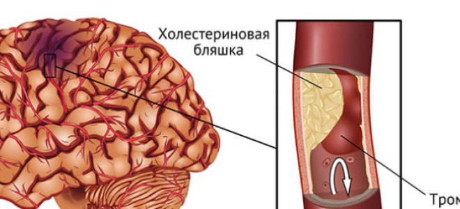 Геморрагический инфаркт головного мозга