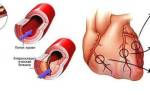 Хроническая ишемия болезнь сердца