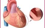 Абдоминальная форма инфаркта миокарда симптомы