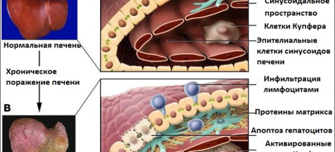 Фиброз печени портальная гипертензия