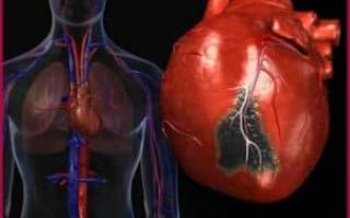 Атипичные формы инфаркта миокарда