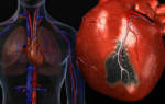 Вторичная профилактика инфаркта миокарда