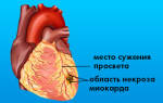 Мелкоочаговый инфаркт миокарда экг