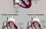 Гипертензия правого желудочка сердца