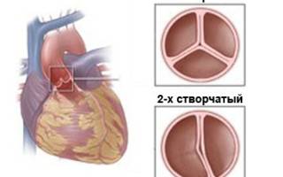 Врожденный порок сердца двухстворчатый аортальный клапан