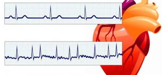 Приступ аритмии симптомы неотложная помощь