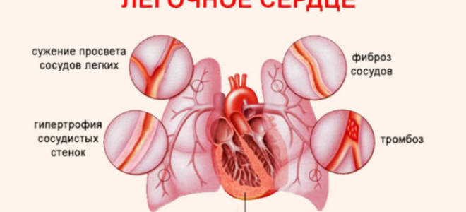 Сердечно легочная недостаточность симптомы