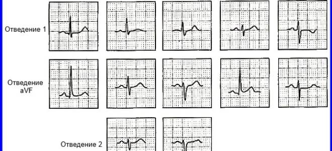 Синусовая брадикардия отклонение эос влево