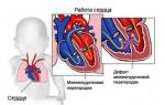 Врожденный порок сердца дефект межжелудочковой перегородки