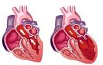 Аневризма левого желудочка после инфаркта